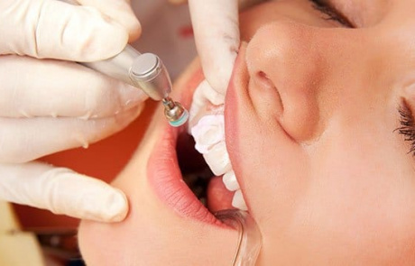 Coronal Polishing